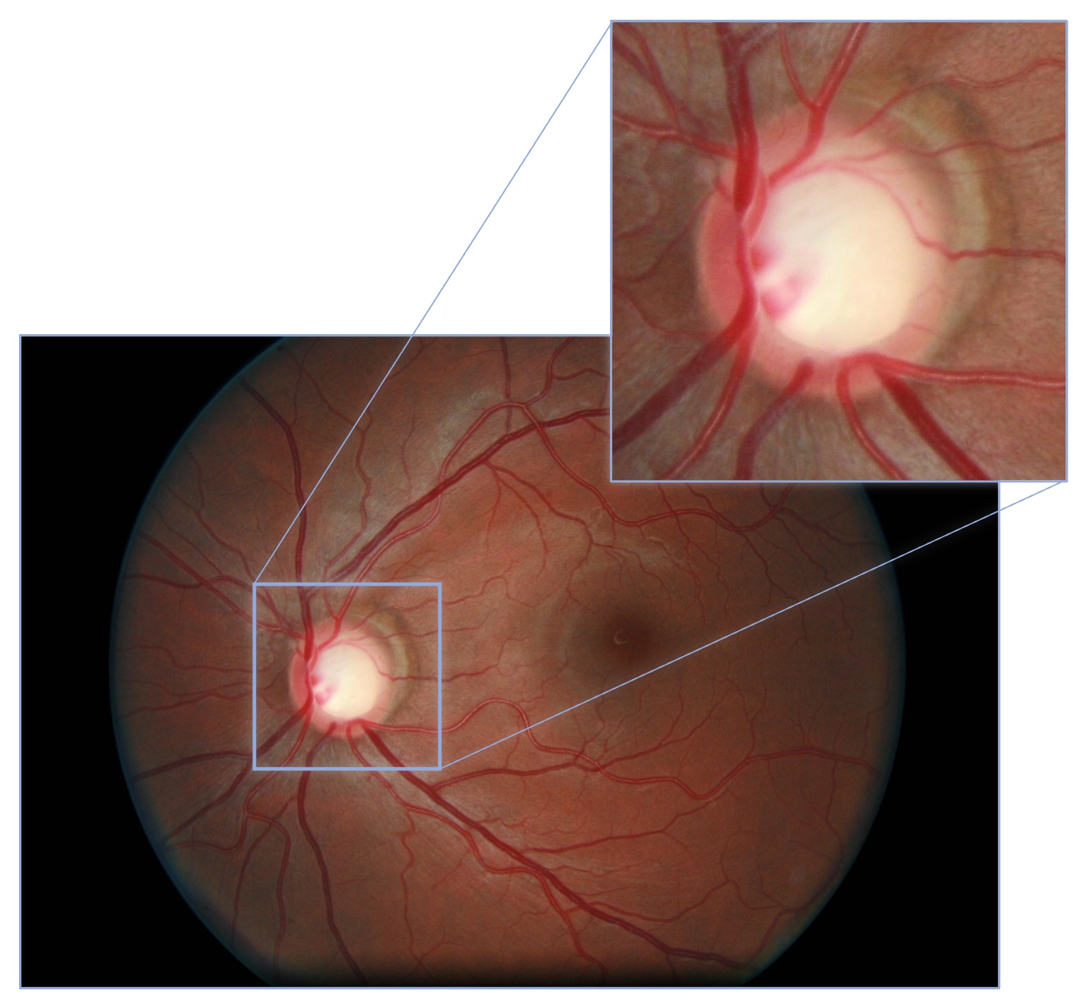 Color fundus image with optic disc pointed out.